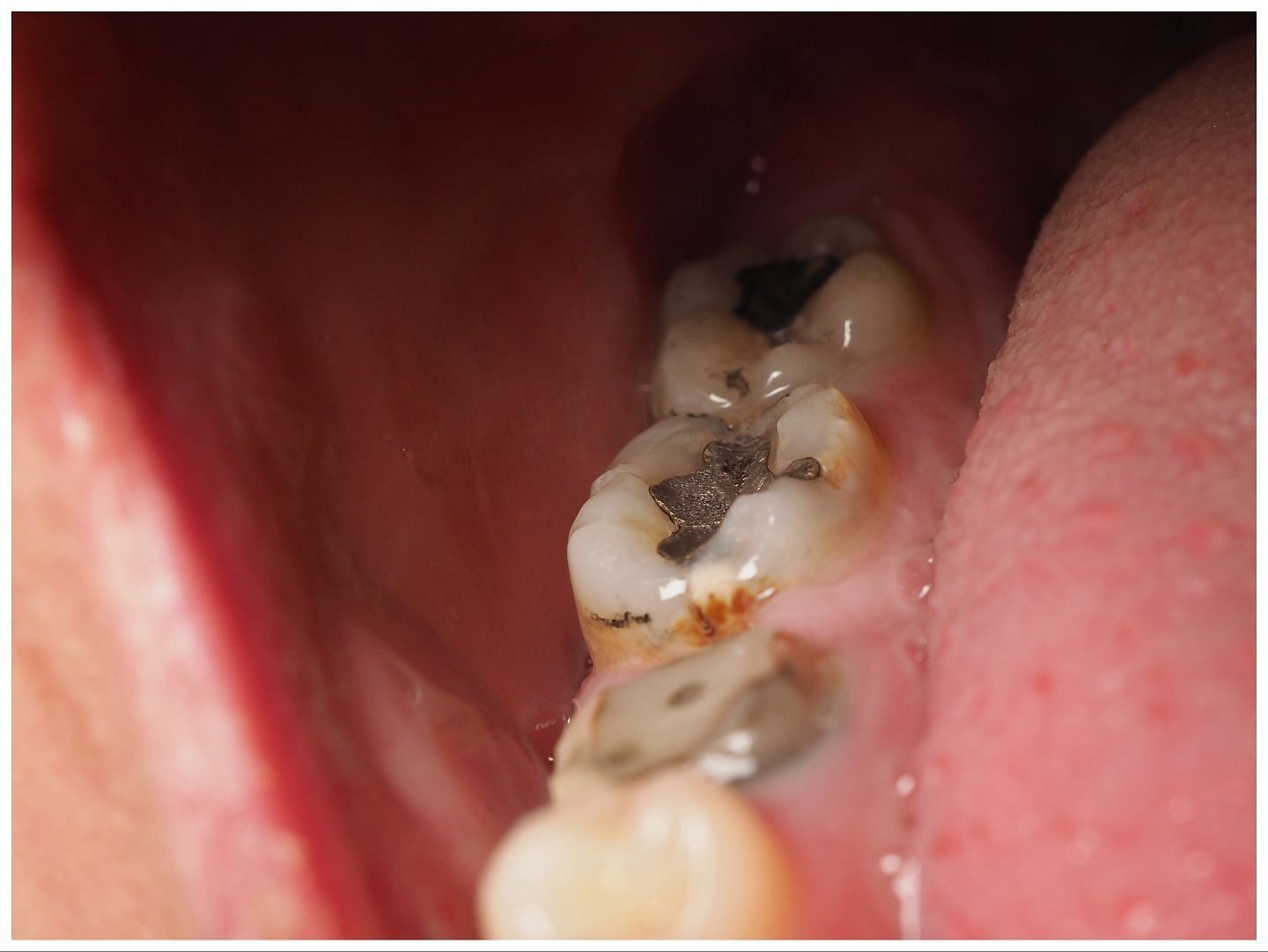Drinking soda can cause cavities (Image via Vecteezy)