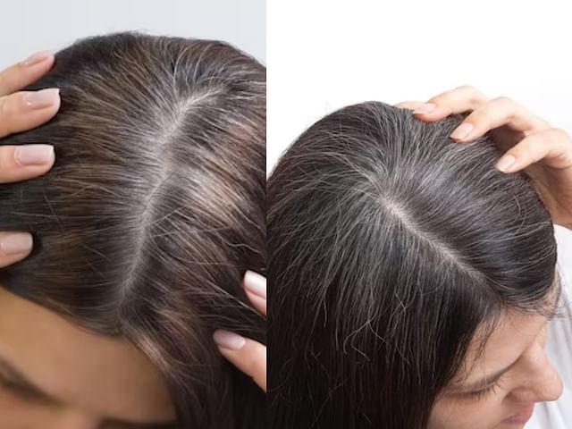 How to prevent white hair? Causes, precautions, and remedies explored | wellhealthorganic.com/know-the-causes-of-white-hair-and-easy-ways-to-prevent-it-naturally