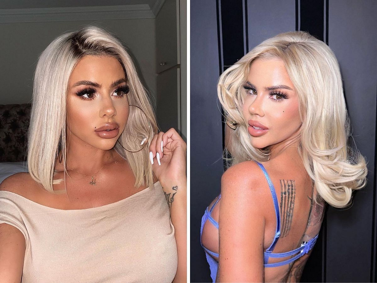 Love Island Hannah Elizabeth before and after cosmetic surgery