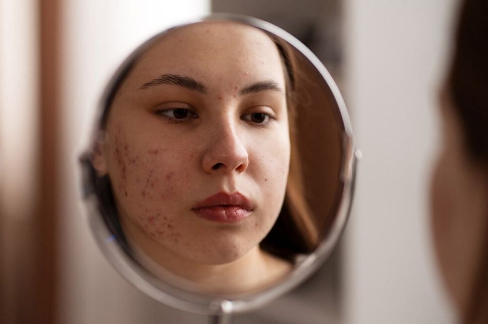 Diving into the reasons for stubborn blemishes (Image via Freepik)