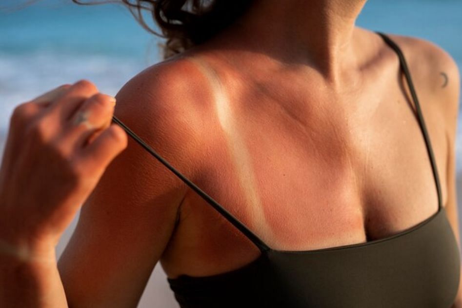 Can help with sunburn (Image via Freepik)