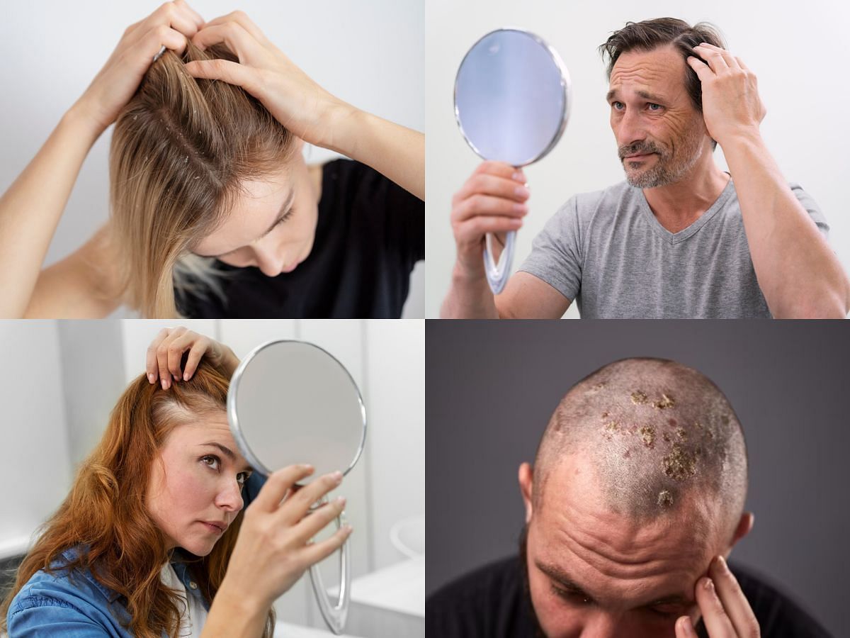 Scalp acne (images via Freepik)