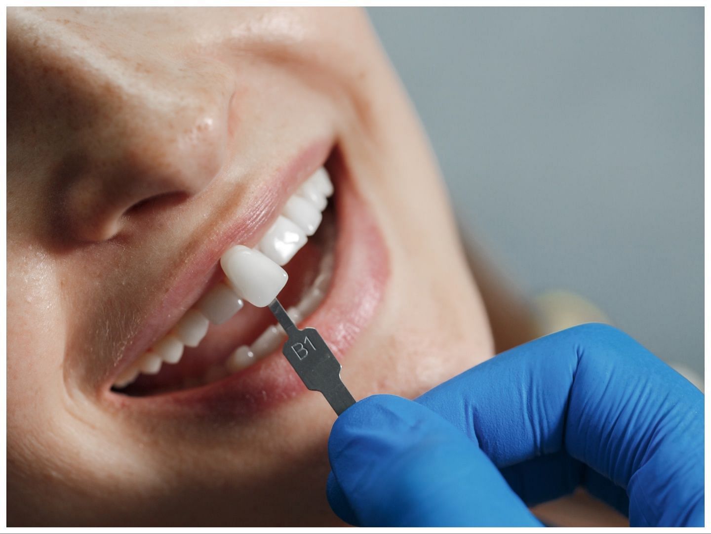 Tooth Veneers - Is It Worth the Smile? (Image via Freepik/ Holiak)