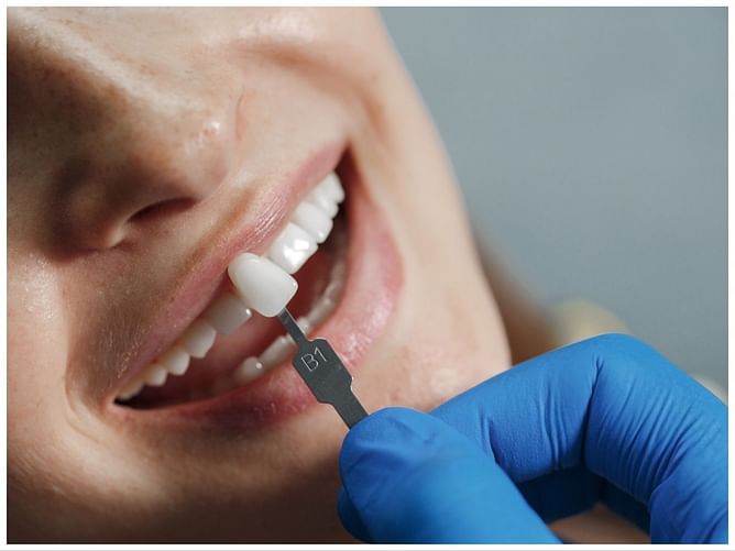 Simple Facts to Know About Tooth Veneers