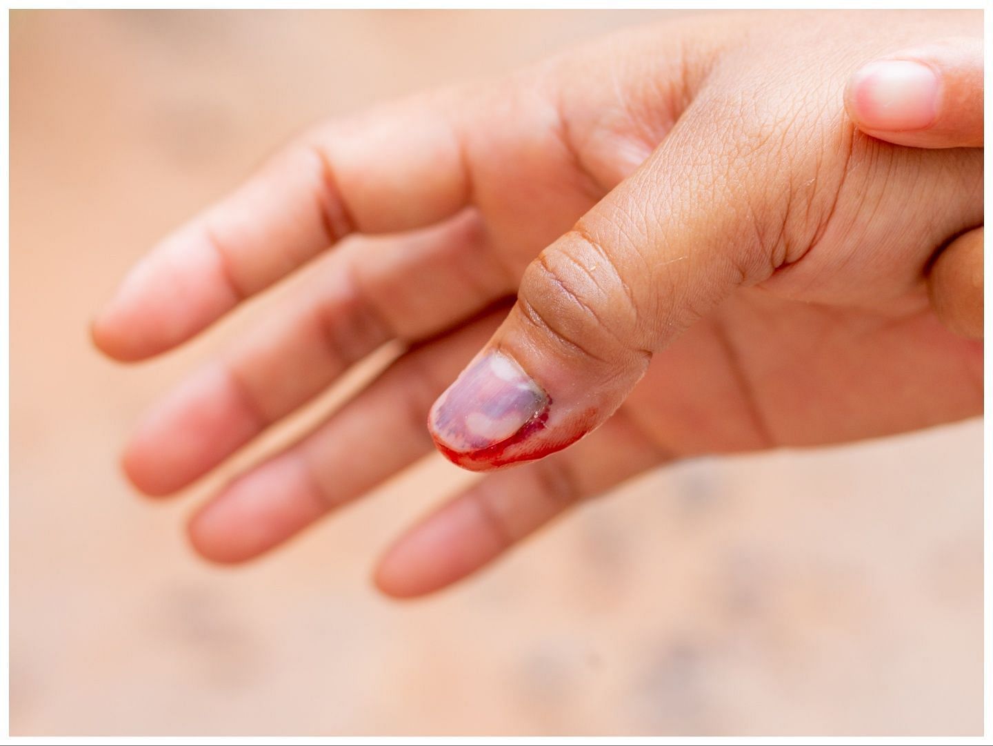 Nail infection can permanently damage your nails (Image via Vecteezy)