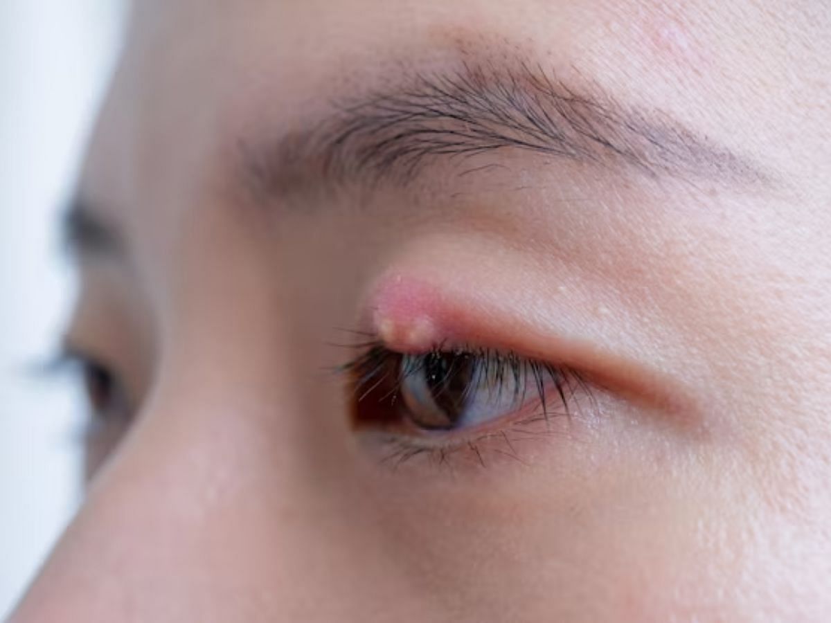 Stye over the eyelid (image via Freepik)