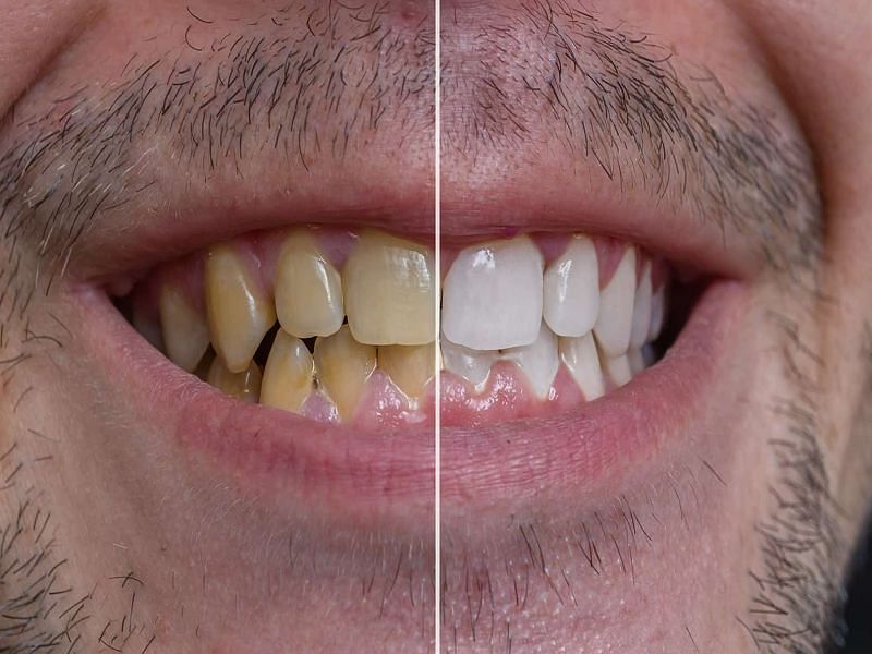 दांतों का पीलापन छुड़ाकर सफेद करेंगी ये चीजें (sportskeeda Hindi) 3
