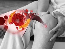 7 Connective Tissue Disorders That Might Ruin Your Physical Health