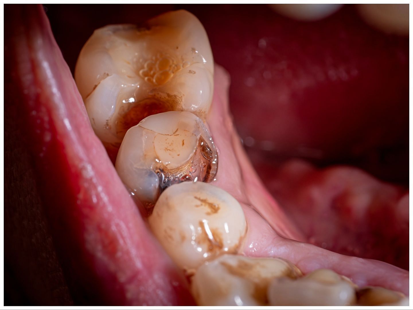 Teeth decay due to acid in soda (Image via Vecteezy)