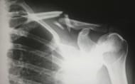 Xray of the chest to determine underlying wheezing causes (Image by Harlie Raethel/Unsplash)