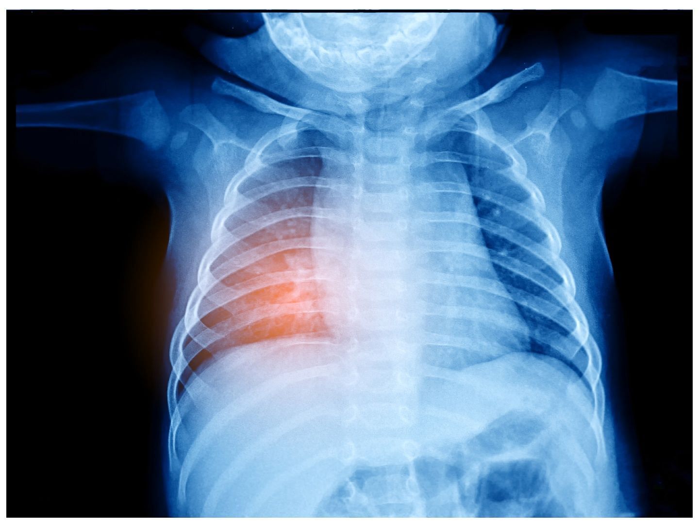 Injury to your rib can cause pain (Image via Vecteezy)