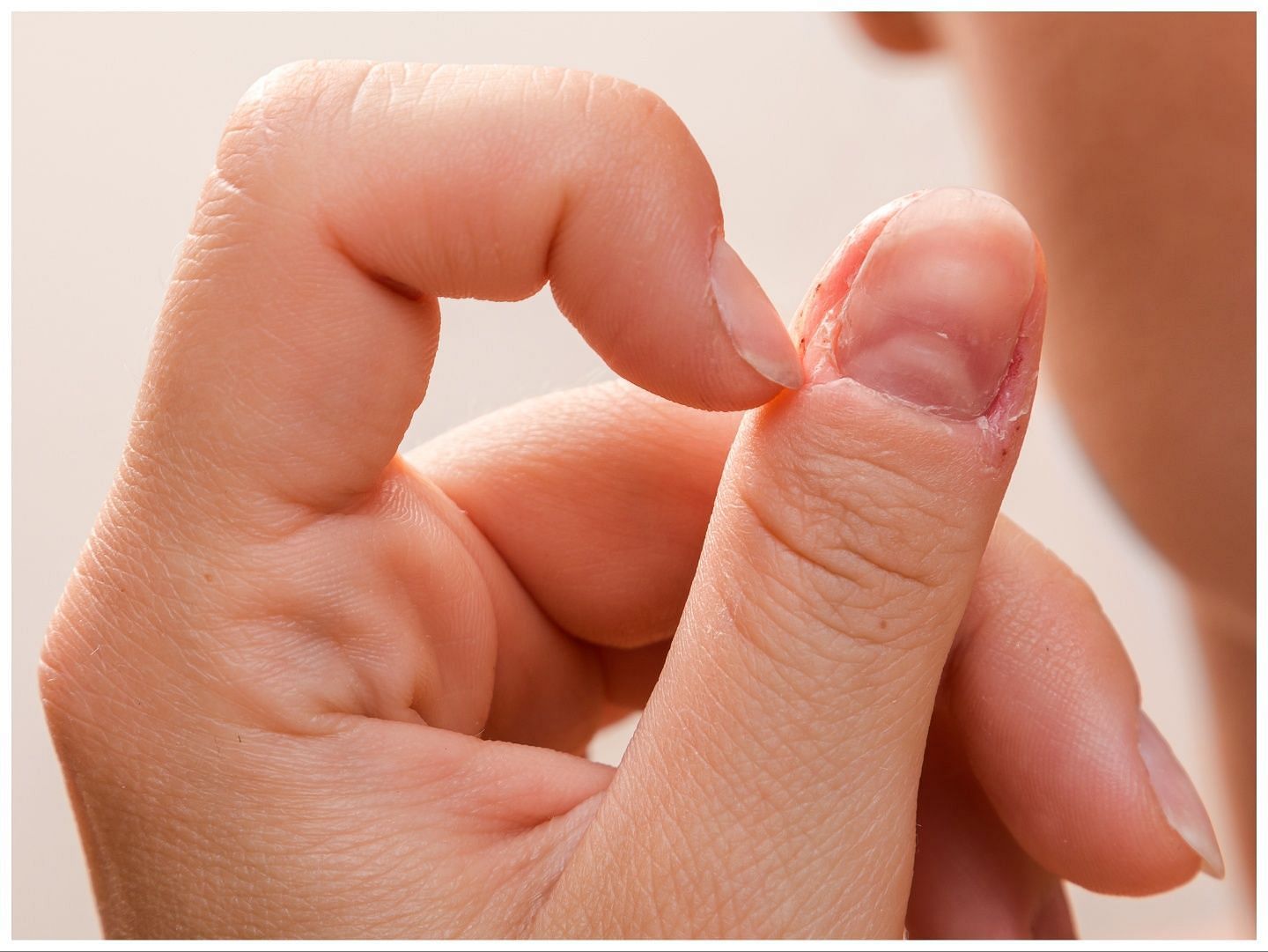 Nail biting habit needs to be changed for better health (Image via Vecteezy)