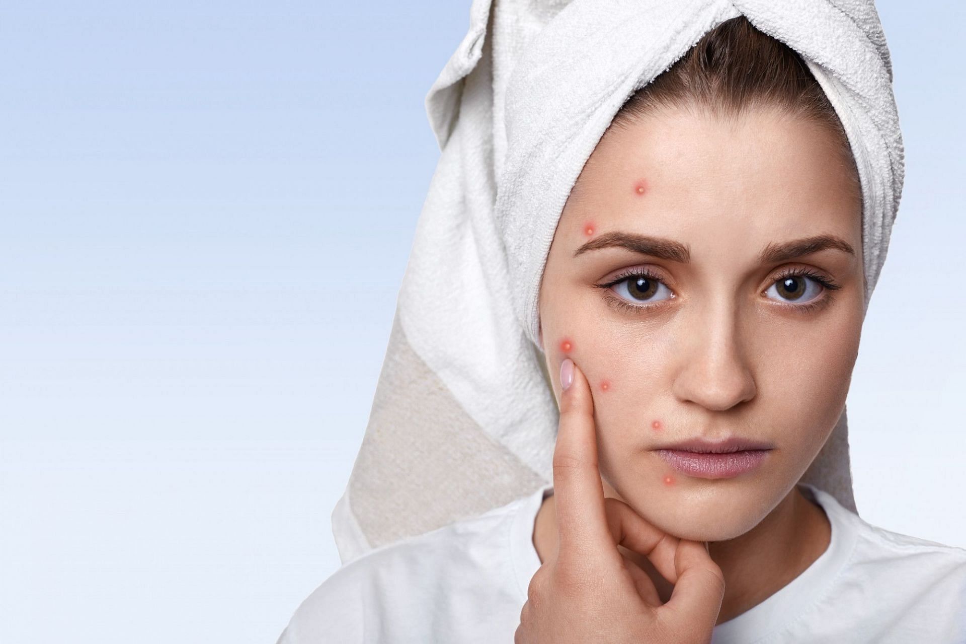 Ayurvedic Remedies for Acne (Image via Freepik)