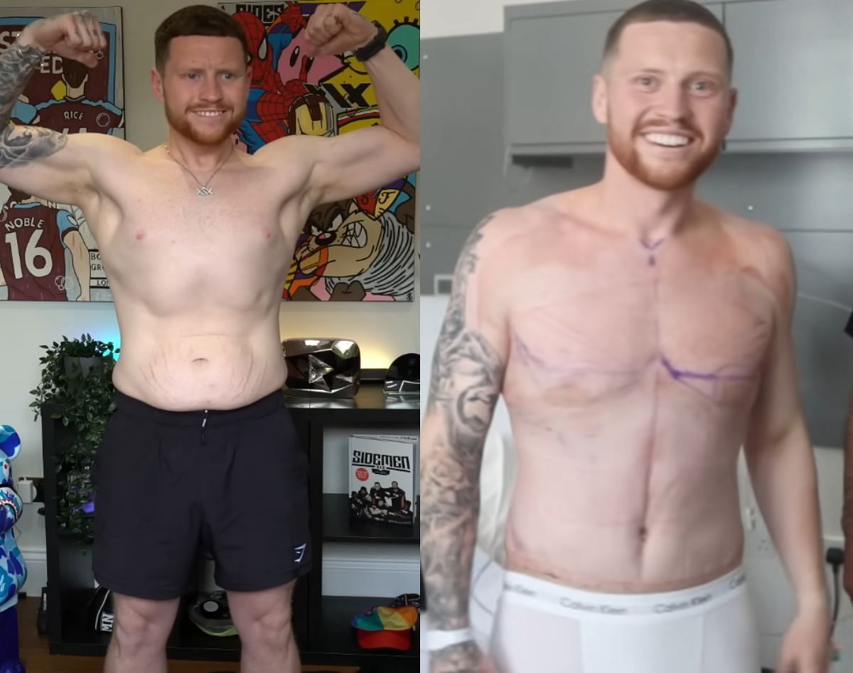Before and after comparison of the surgery (Image via YouTube/Behzinga)