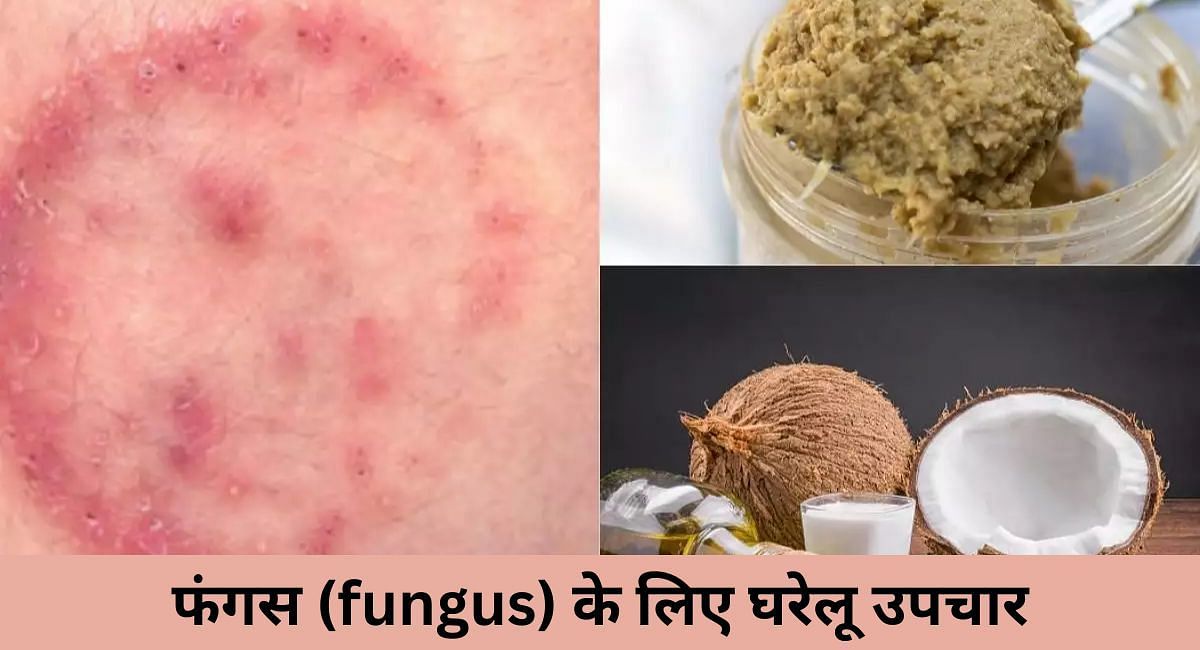 फंगस (fungus) के लिए 6 घरेलू उपचार (फोटो - sportskeedaहिन्दी)