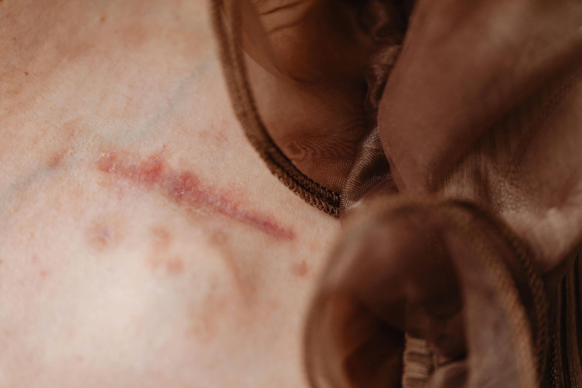 8 tips to reduce scars after surgery(image sourced via Pexels / Photo by karolina)