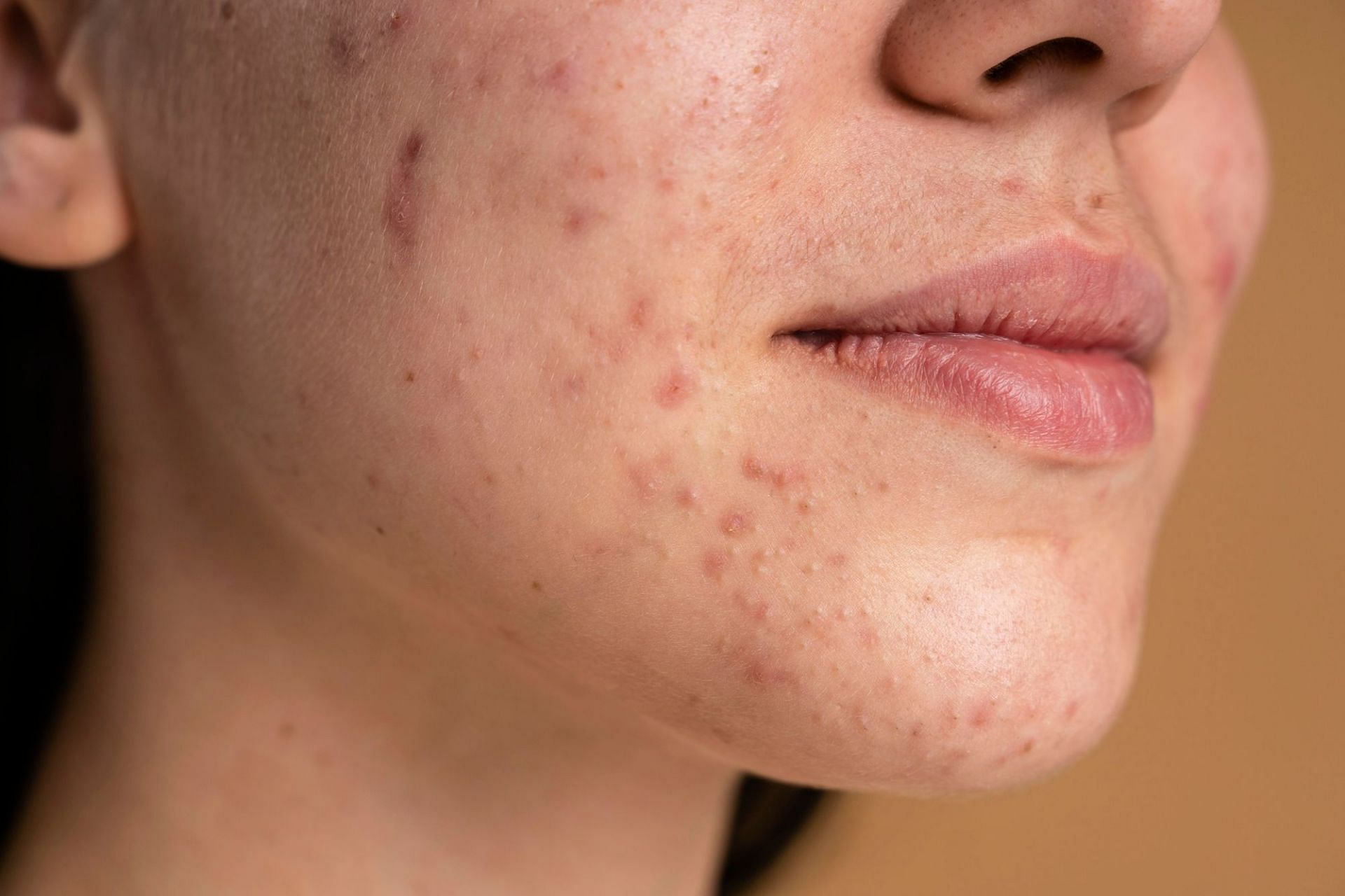 acne prevention (Image by Freepik on Freepik)