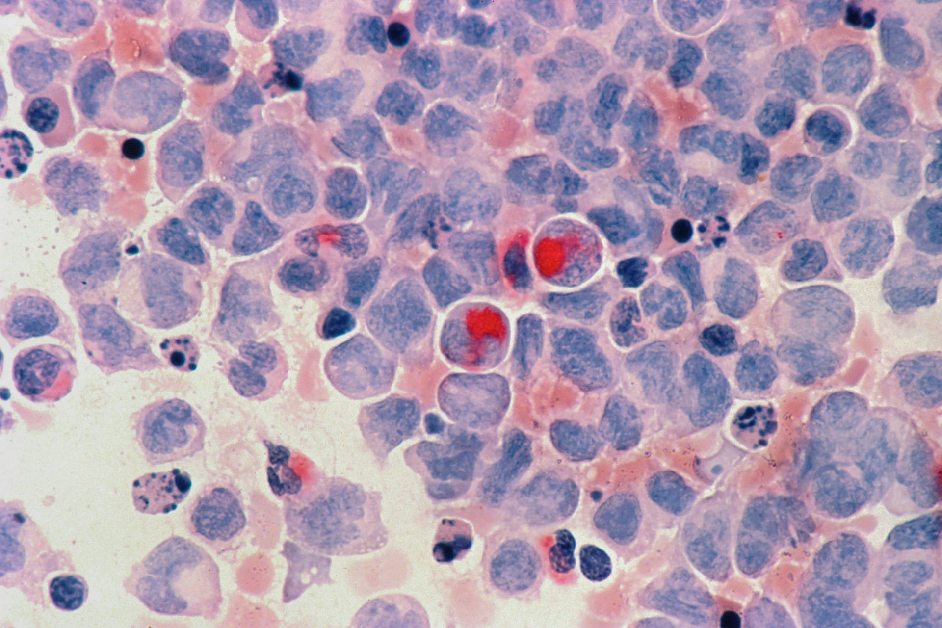 Cancer of the blood cells (Image by NCI/Unsplash)