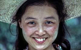 Here is everything you need to know about papulopustular rosacea