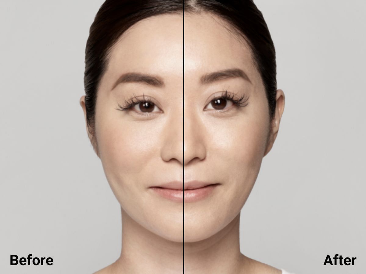 Effect of Restylane injections (image vis restylane)