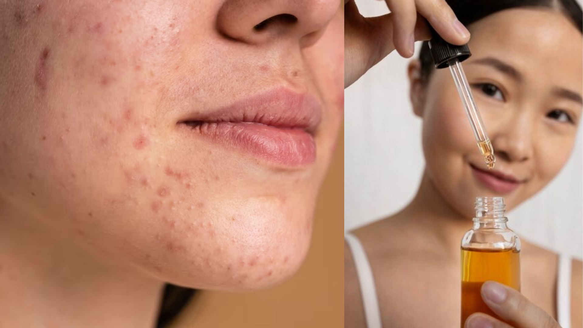 How to get rid of Chin Acne? Reasons, Treatment and more details explored
