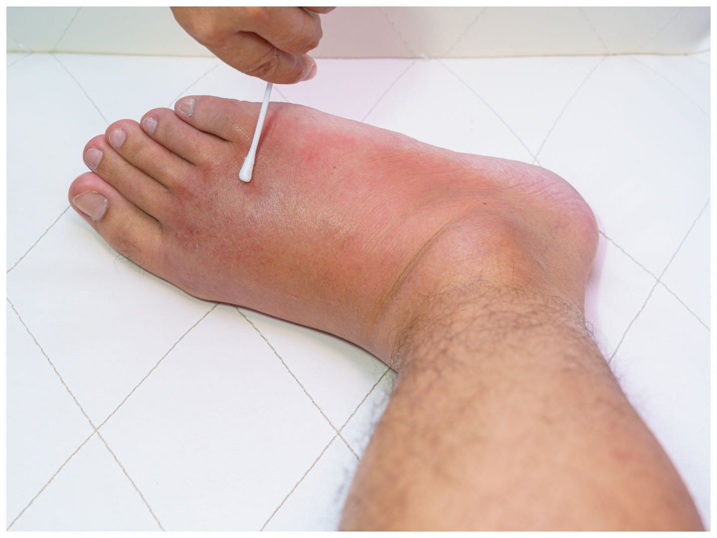 It is a skin infection that makes your skin red and swollen (Image via Vecteezy)