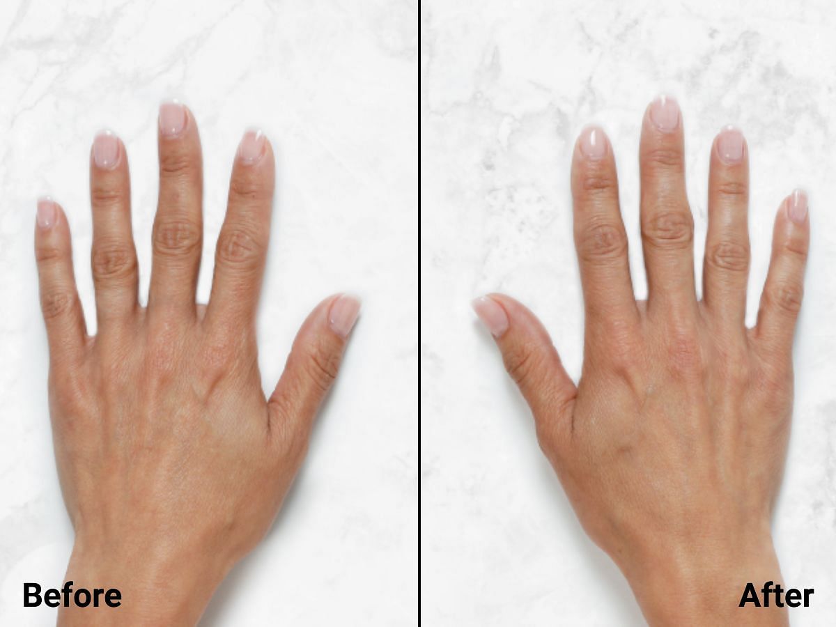 Treated with 1 mL of Restylane® Lyft per hand (image via Restylane)