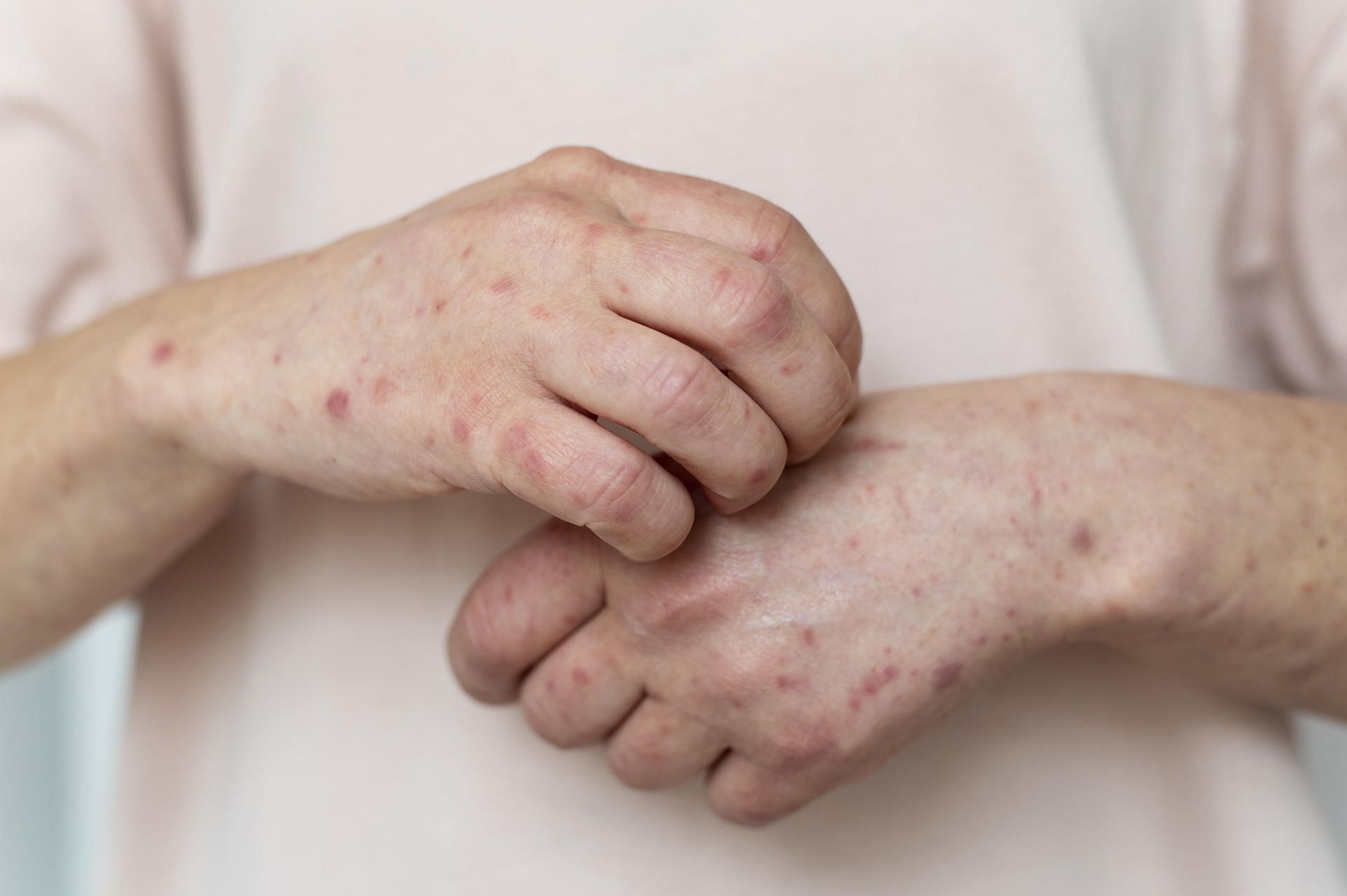 Are you suffering from shingles? (Image by freepik)
