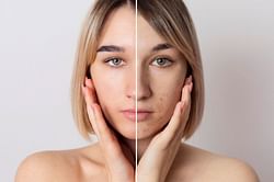 Bumps on face? Try the most effective ways to get rid of it
