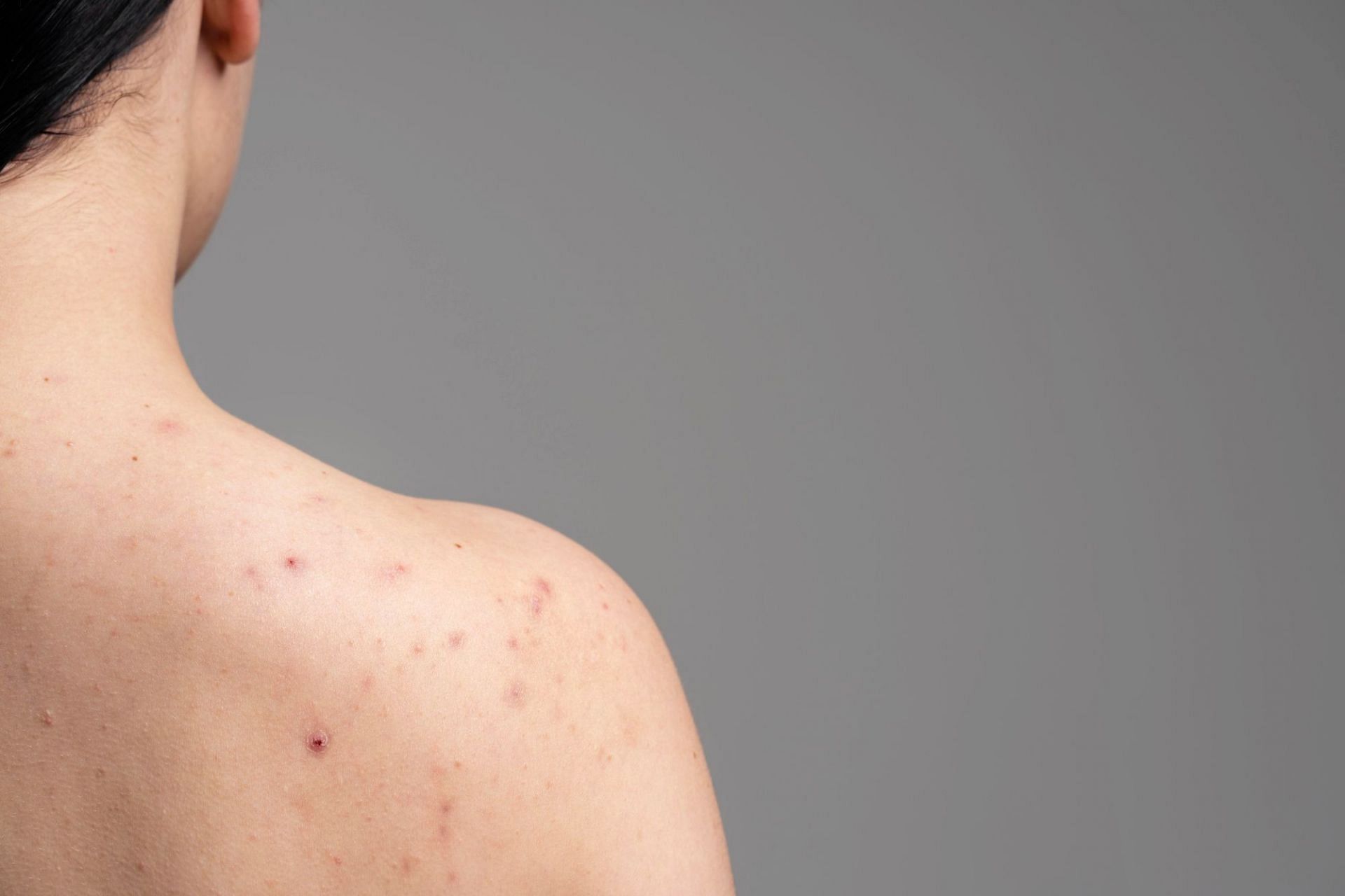 Back acne because of steroid use (Image by Freepik)