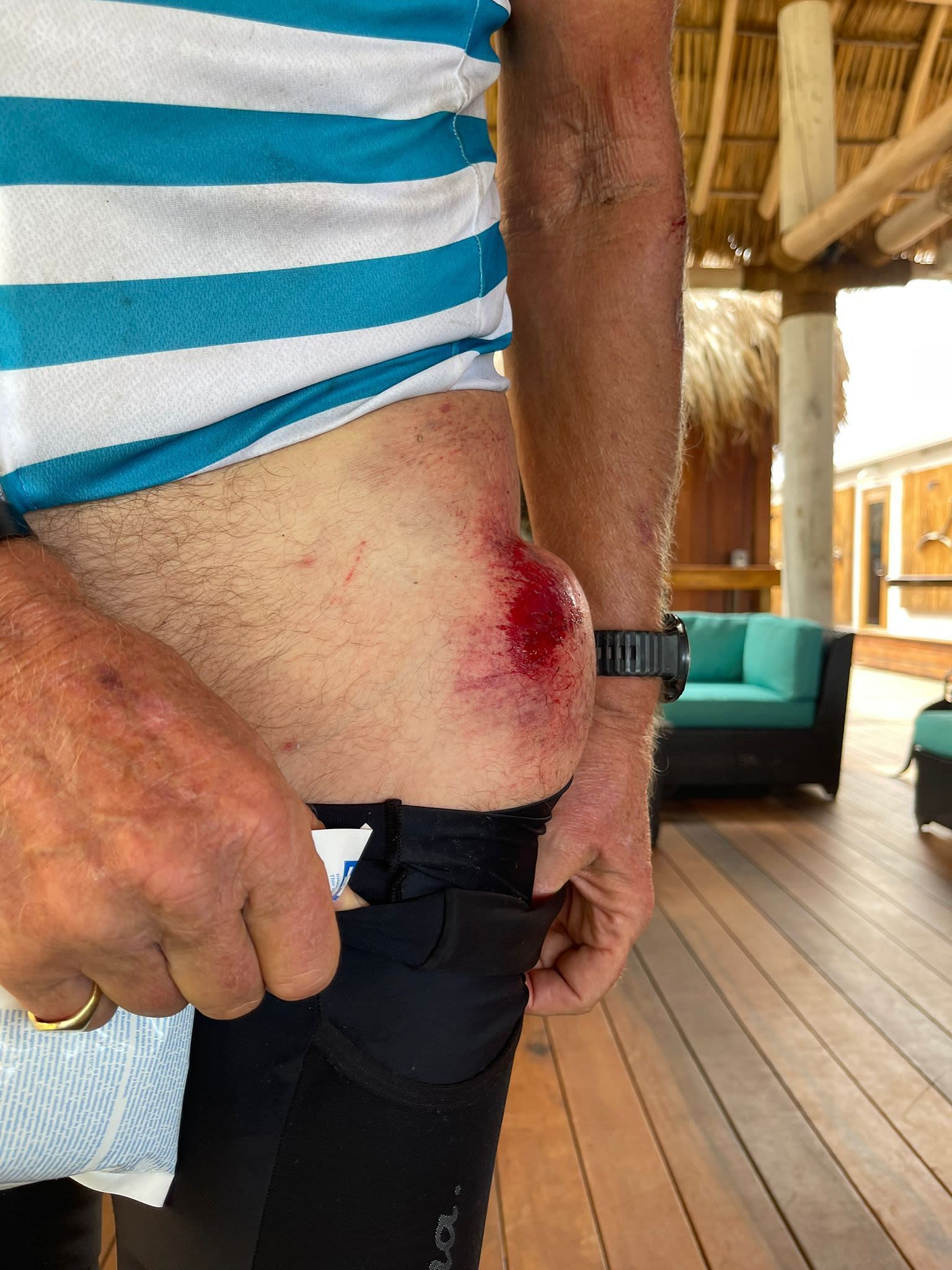Richard Branson got a big bump on his hip after his bike crashed in 2021 (Image via Virgin Group website)