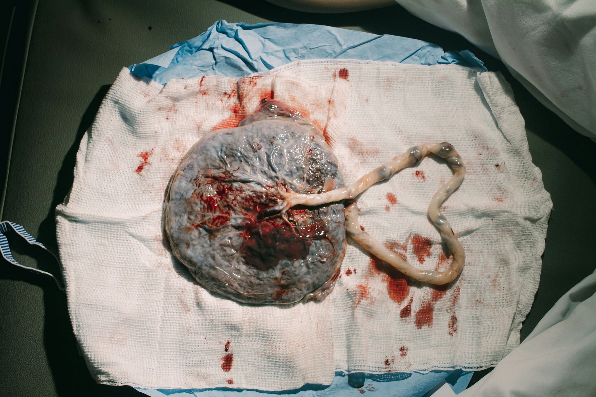 Umbilical hernia is related to the umbilical cord (Image by Joao Paulo De Souza Oliveira/Unsplash)