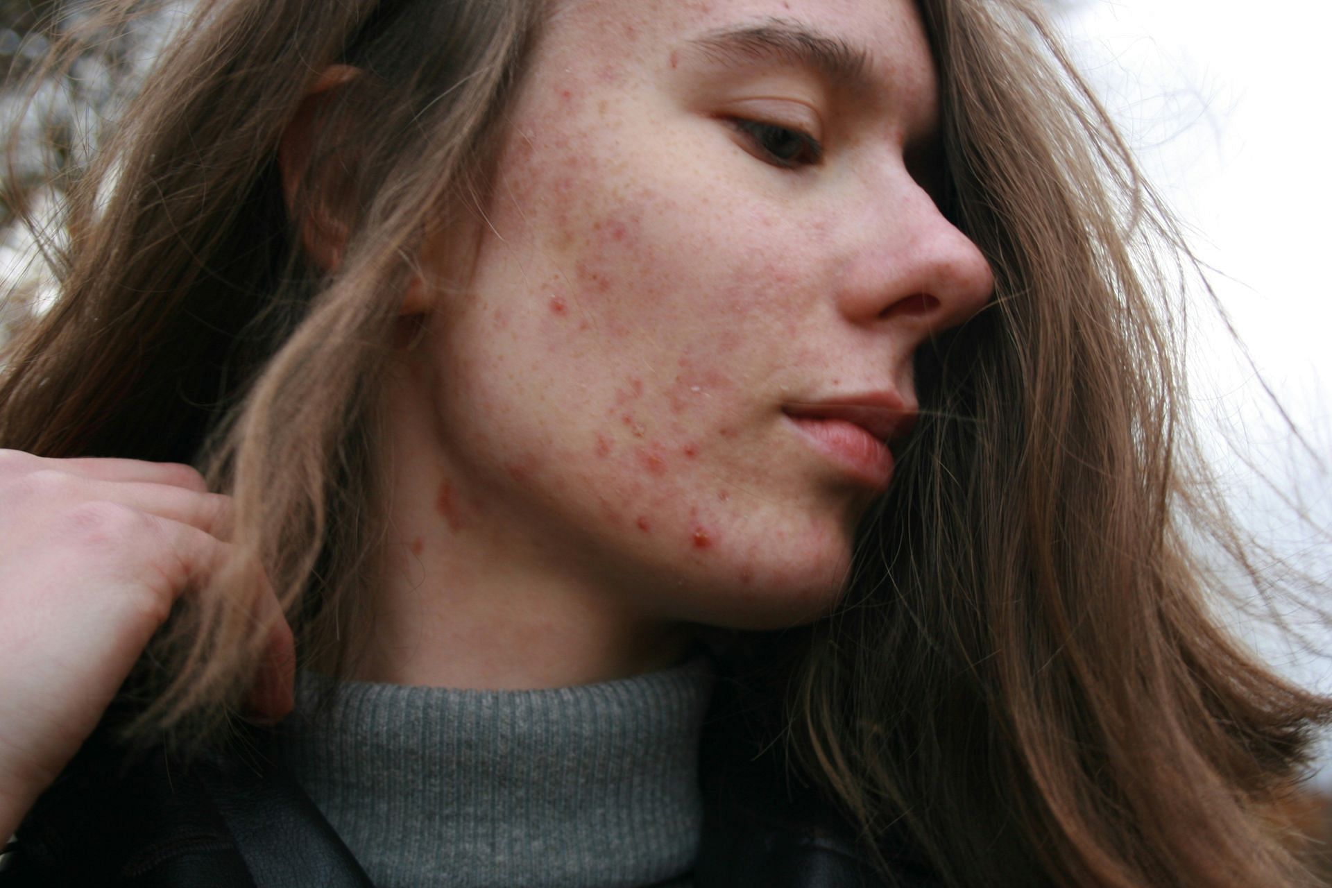 How is this condition different from acne? (Image by Barbara Krysztofiak/Unsplash)