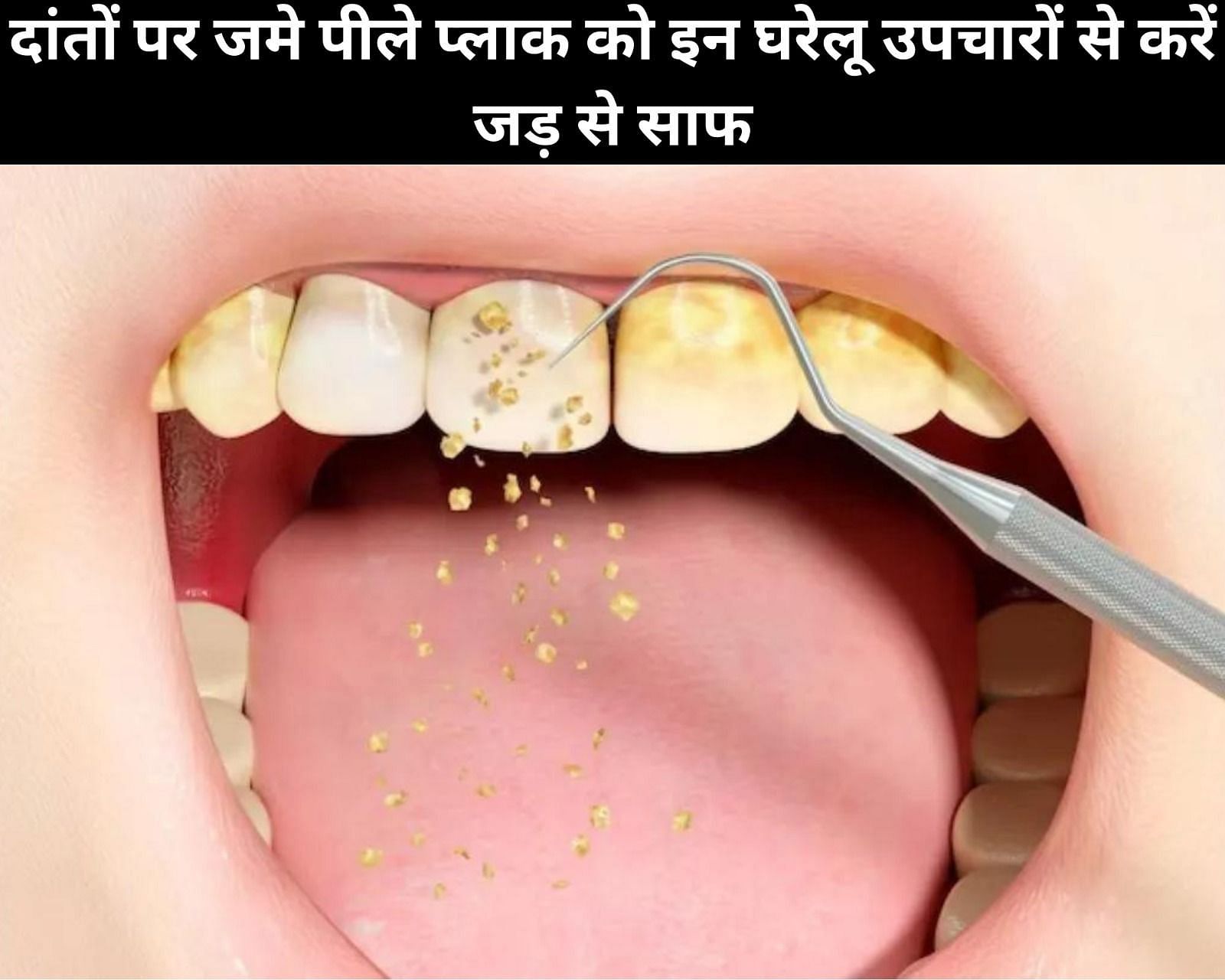 दांतों पर जमे पीले प्लाक को इन 5 घरेलू उपचारों से करें जड़ से साफ (फोटो - sportskeedaहिन्दी)