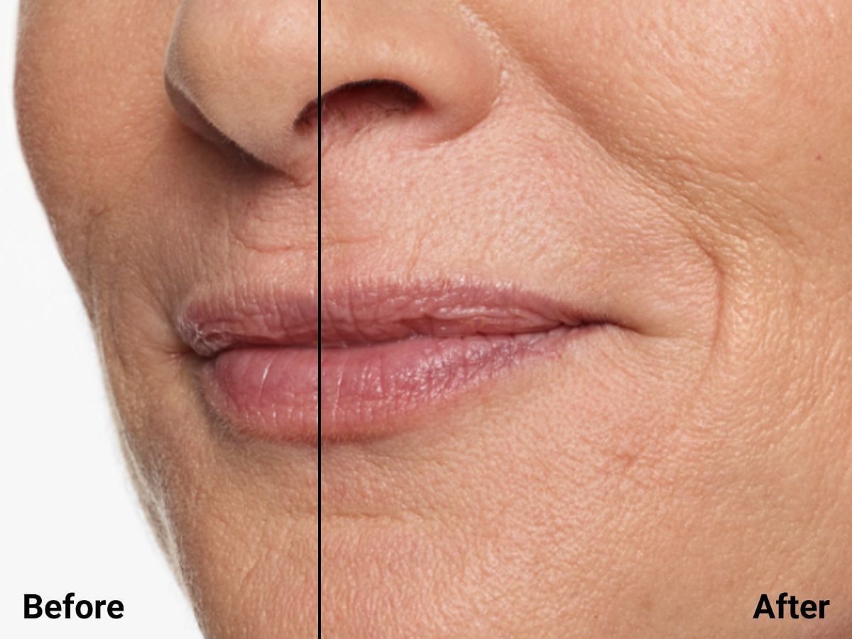 Restylane Silk on the lips and around the mouth (image vis Restylane)
