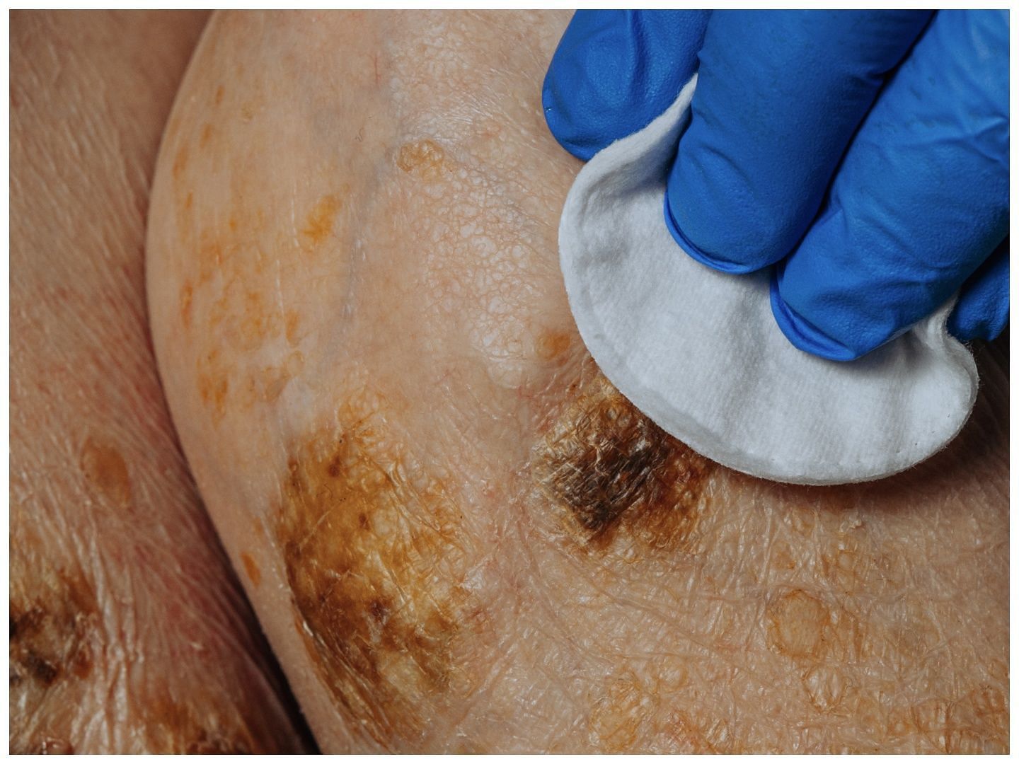 Cleaning the wound is important as it kills unwanted bacteria (Image via Vecteezy)