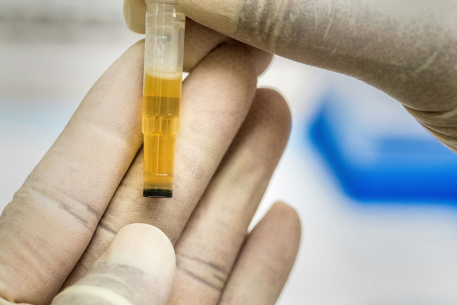 Excess bile can result in yellow urine (Image by CDC/Unsplash)