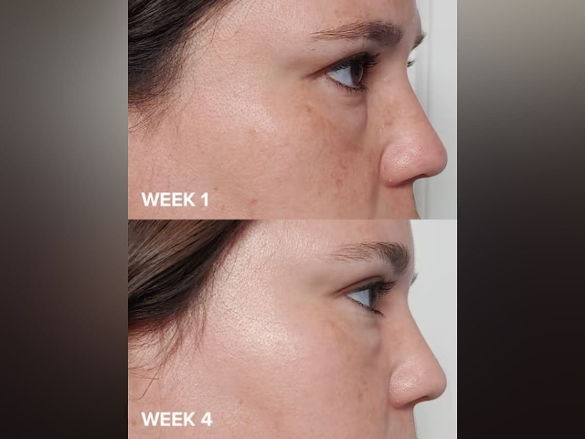 Effect of Paula&#039;s Choice exfoliant (image via Paula&#039;s Choice)