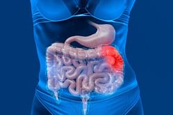 Struggling with gut inflammation? Look at the strategies to prevent it