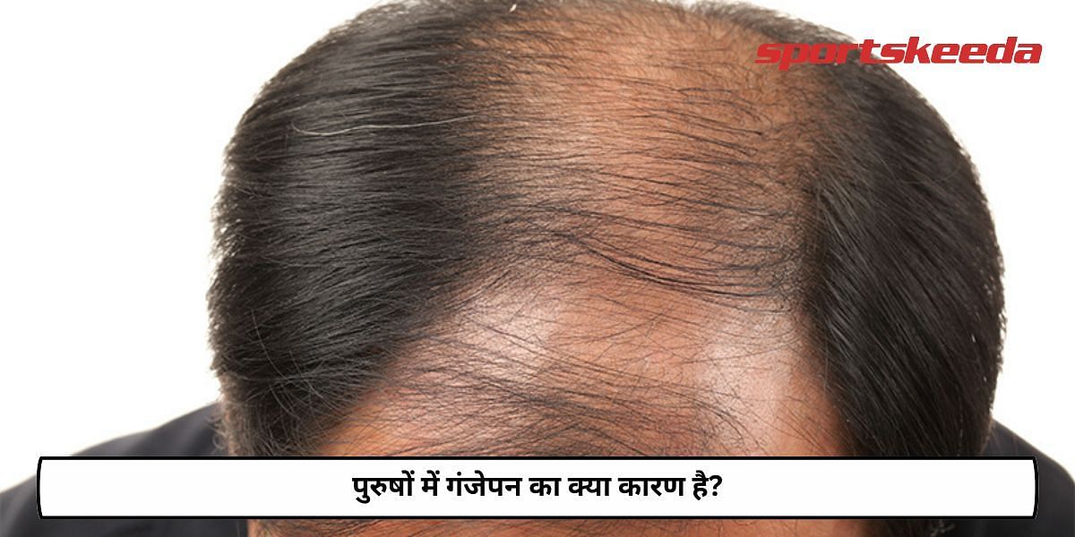 What Causes Baldness In Men?