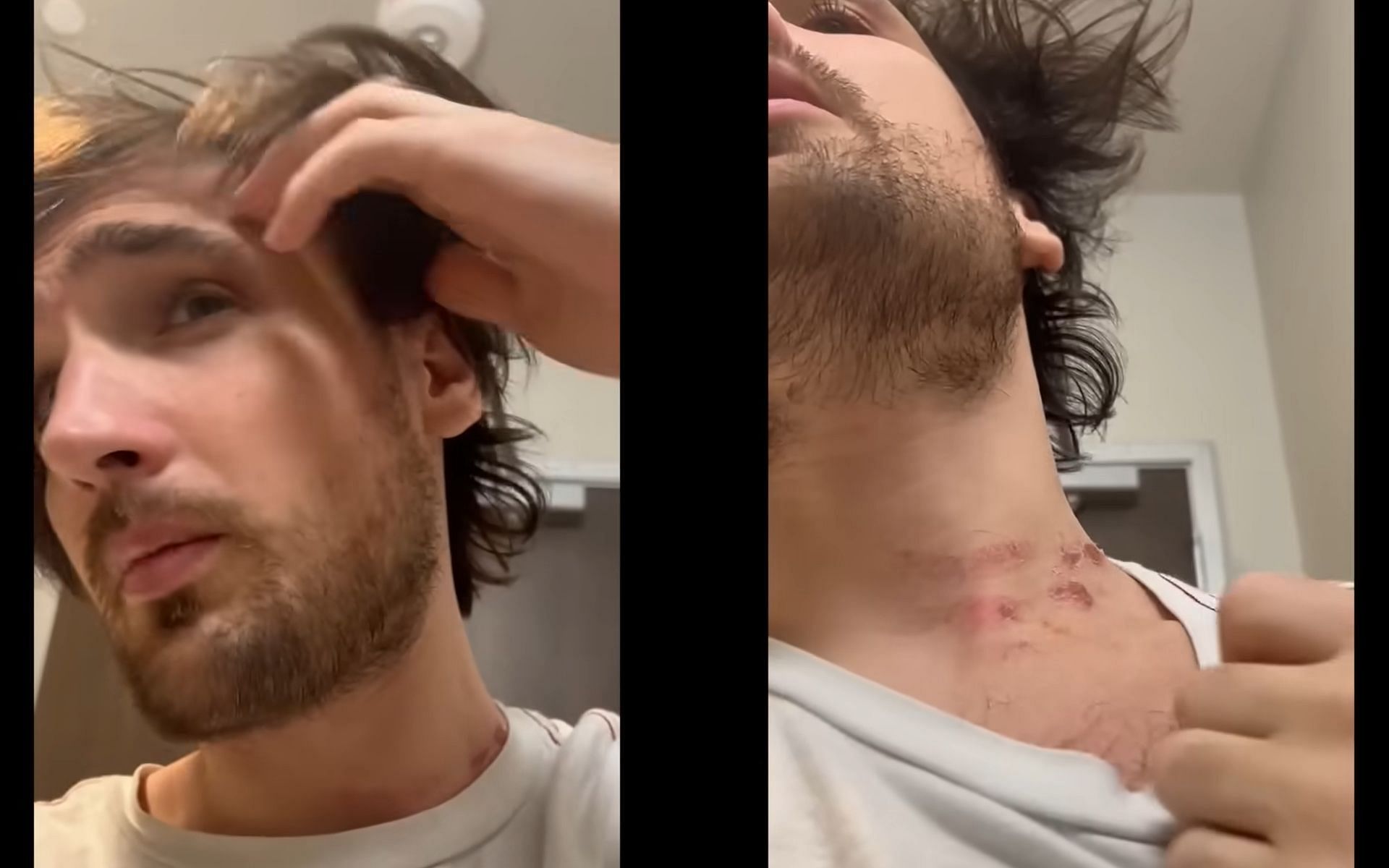 Mitch Jones displays bruises on his body (Image via Mitch Jones/YouTube)