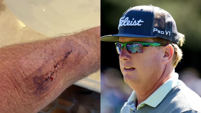 What is the scar on Charley Hoffman’s forearm? Golfer’s serious medical condition and everything about it