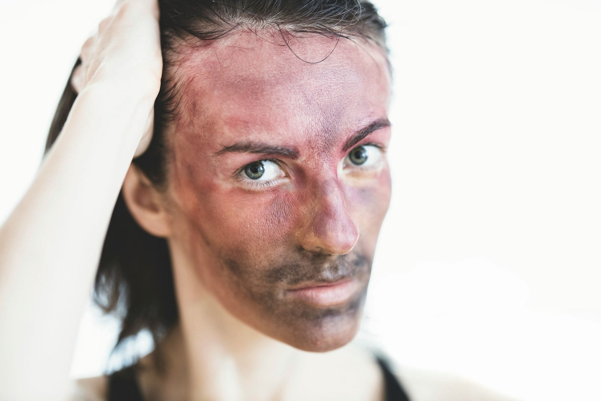 Skin redness can be caused because of this condition. (Image by Engin Akyurt/Unsplash)