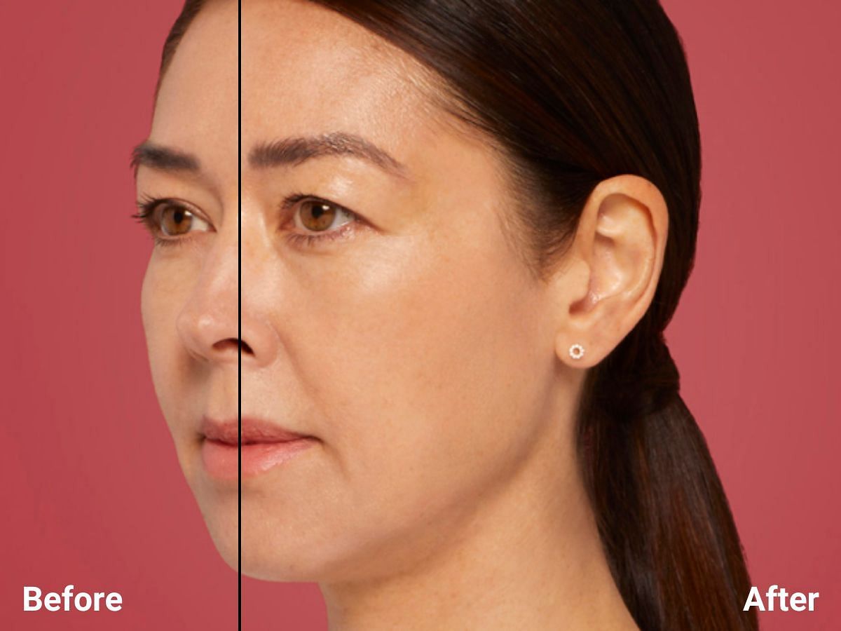 Restylane Contour in the cheeks (image via Restylane)