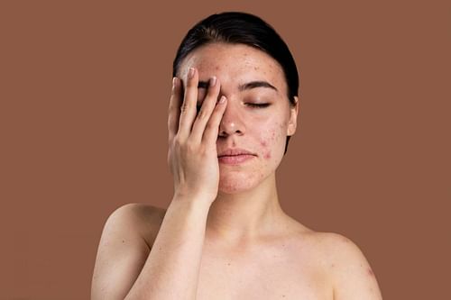 Natural Scar Remedies (Image via Freepik)