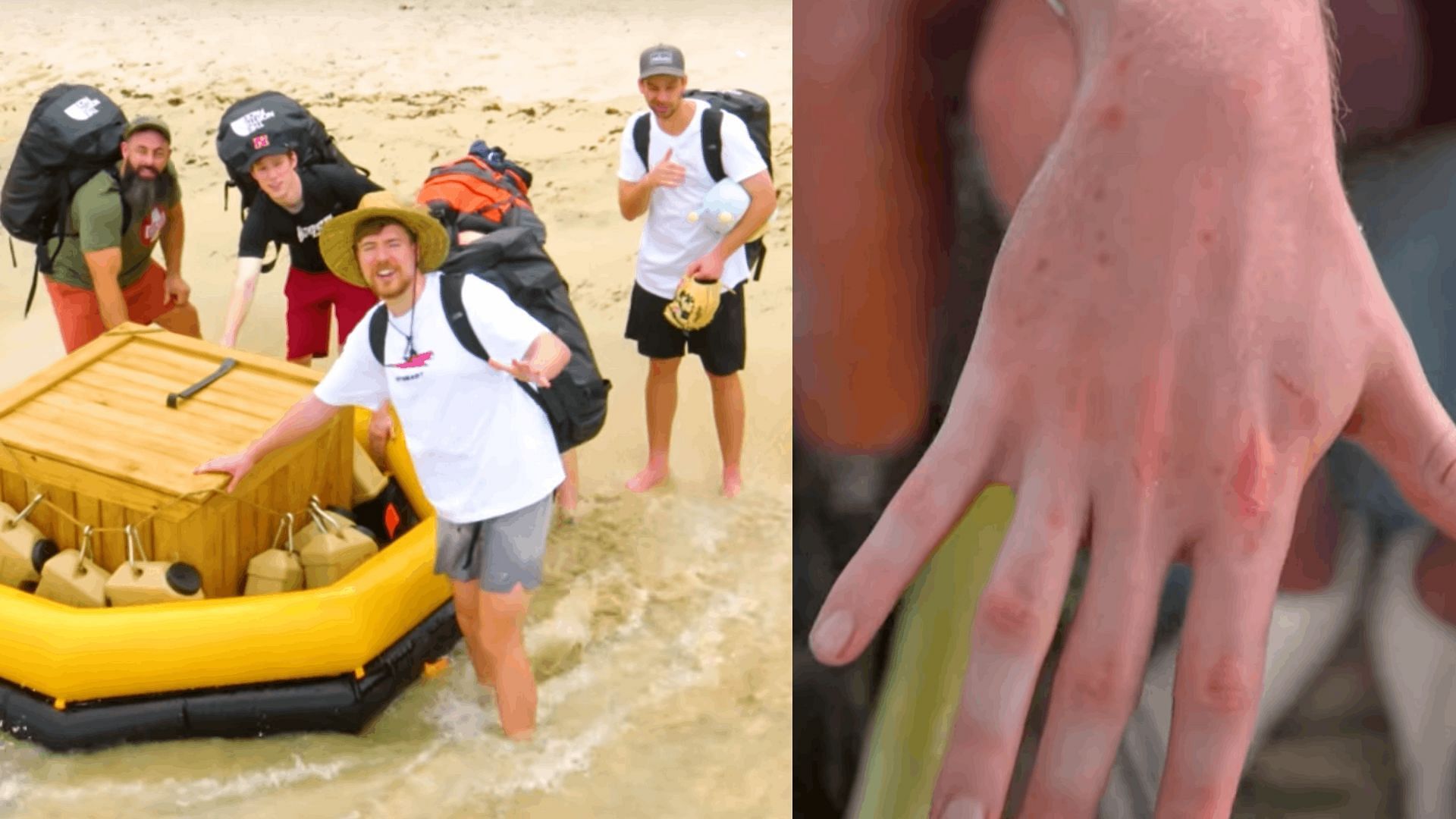 MrBeast was afflicted by bug bites and sunburn in his latest video (Image via MrBeast/YouTube)