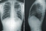Smoking and cancer: What percentage of smokers get lung cancer?