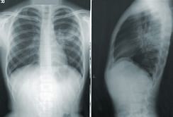 Smoking and cancer: What percentage of smokers get lung cancer?