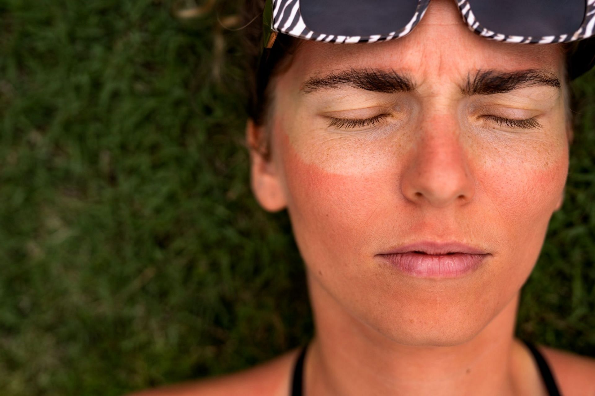 Exposure to the sun&#039;s ultraviolet rays can cause the red ear syndrome (Image by freepik)