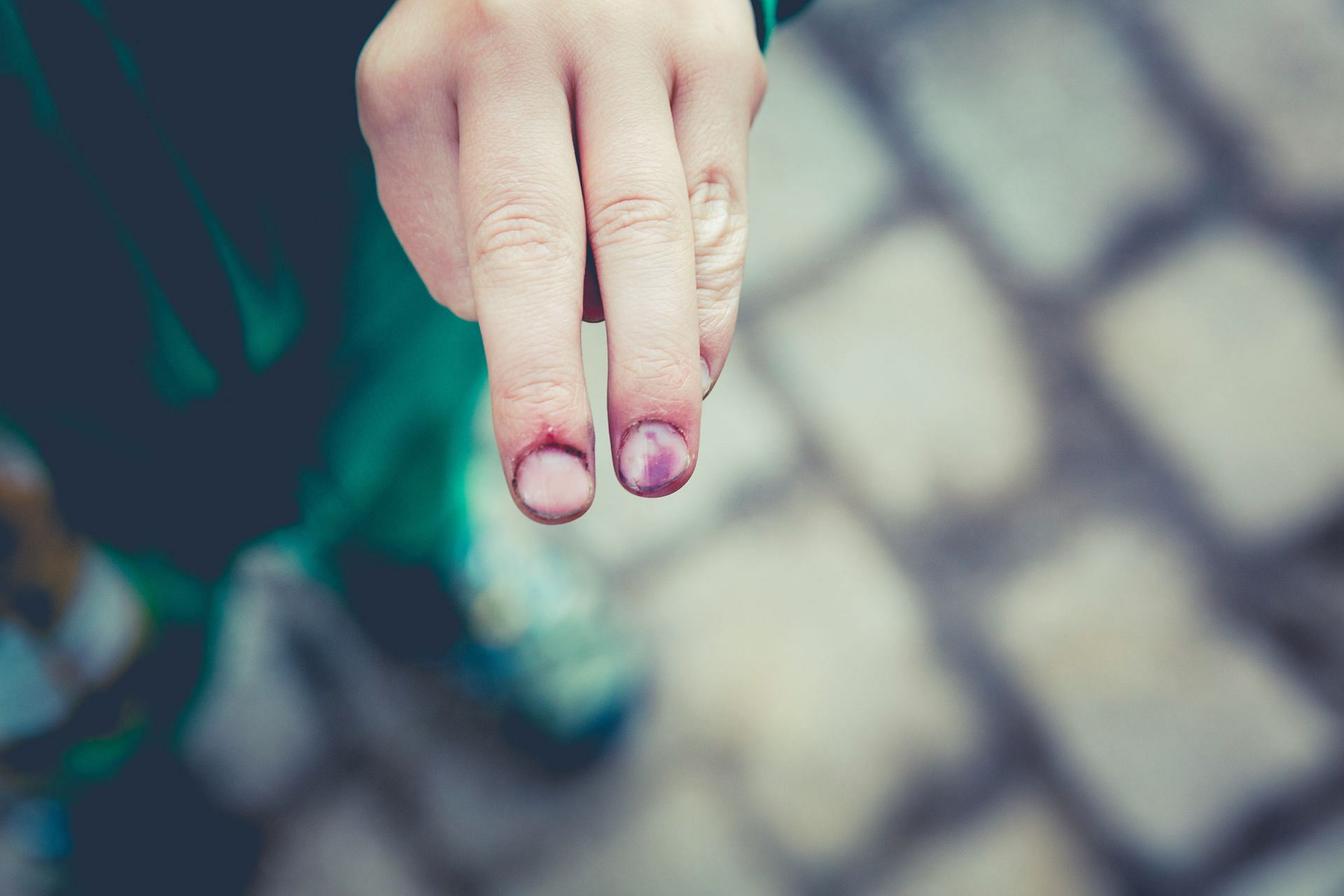 What is a jammed finger ? (Image by Markus Spiske/Unsplash)